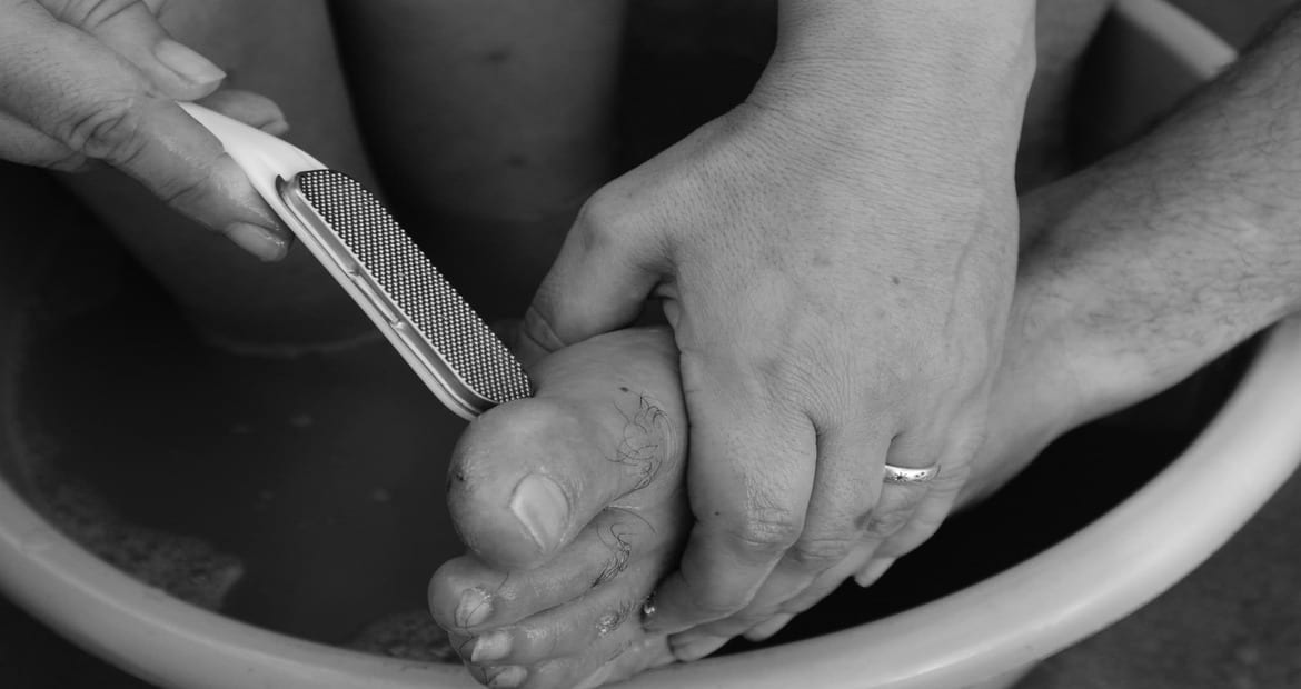 callos en los pies
